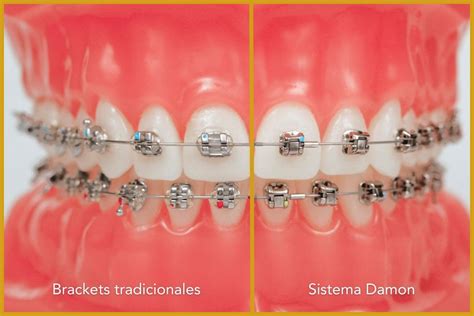 brackets damon esteticos o metalicos|sistema de damon.